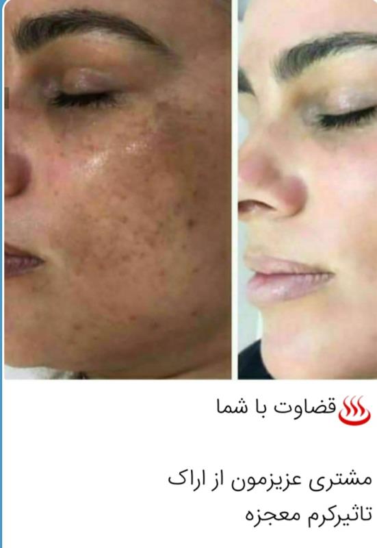 کرم وصابون ضدلک وروشن کننده معجزه شب آسناد