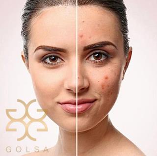 سرم درخت چای (تی تیری) فارماسی