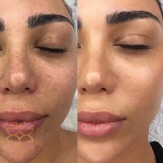 سرم آلفا آربوتین اوردینری