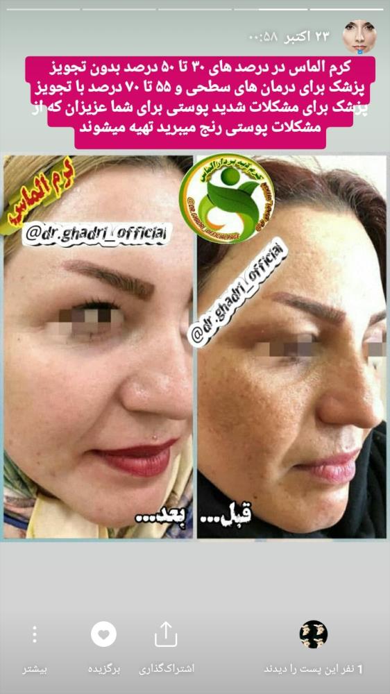 کرم لایه بردار الماس✔ ضدلک ✔ ضدجوش جای جوش✔ روشن وشفاف کننده قوی