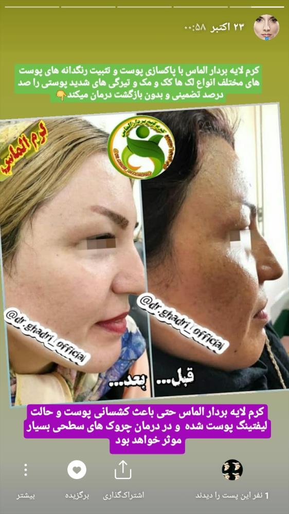 کرم لایه بردار الماس✔ ضدلک ✔ ضدجوش جای جوش✔ روشن وشفاف کننده قوی