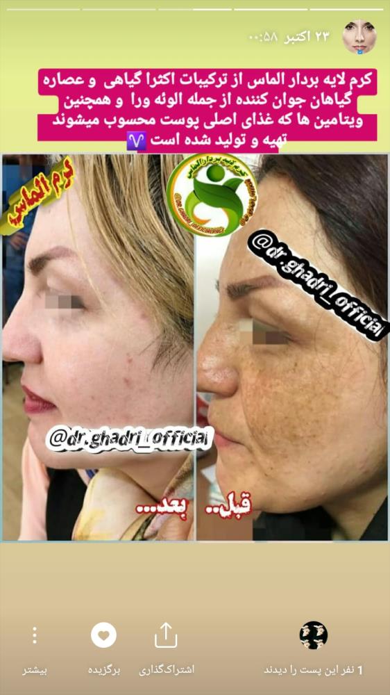 کرم لایه بردار الماس✔ ضدلک ✔ ضدجوش جای جوش✔ روشن وشفاف کننده قوی