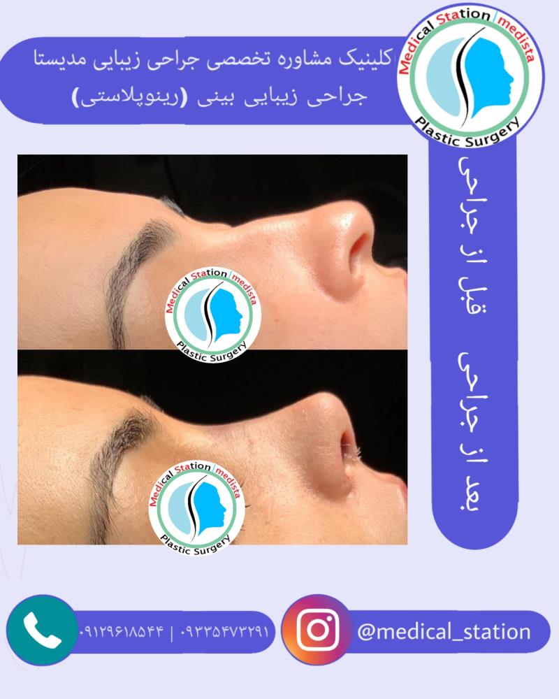 جراحی زیبایی بینی