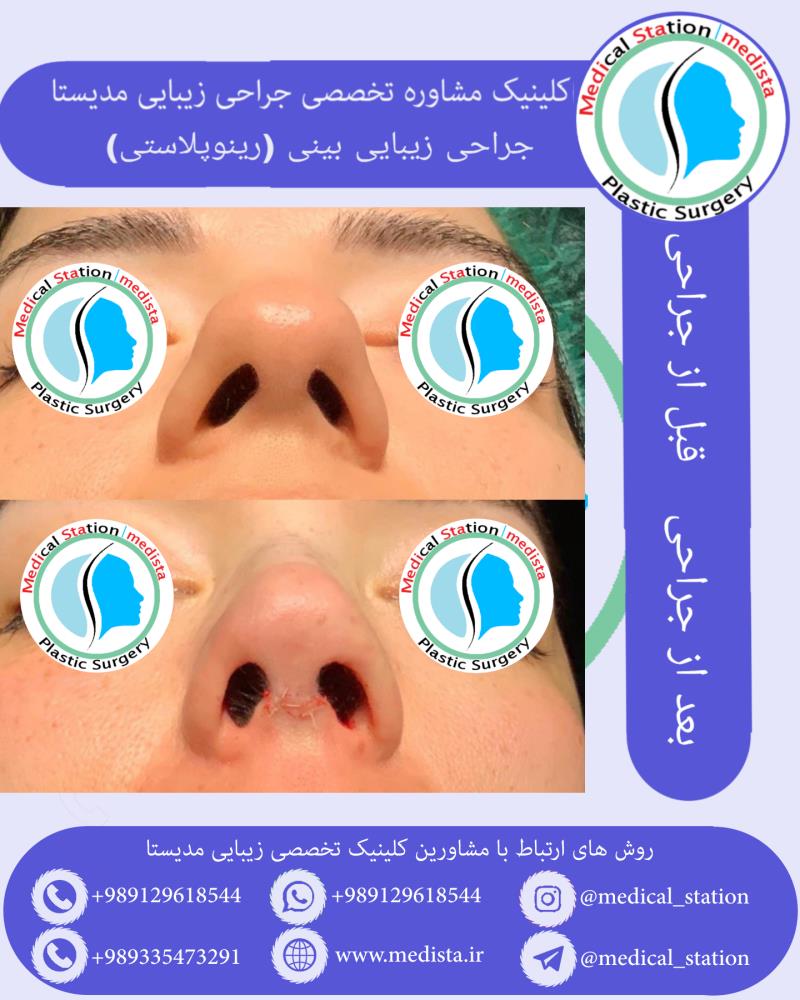 جراحی زیبایی بینی