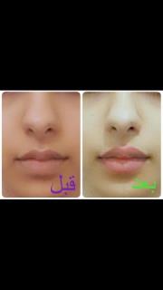 ژل کوچک کننده بینی120میلی گرم