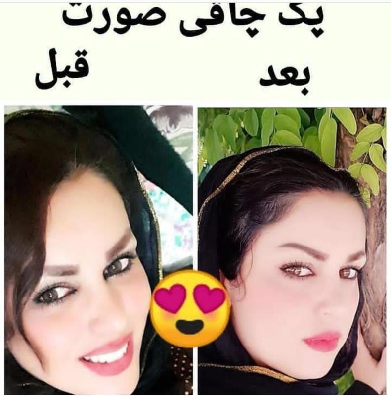 كرم پف صورت وگونه گذار سوماتلين  حجم ٥٠ميلى گرم